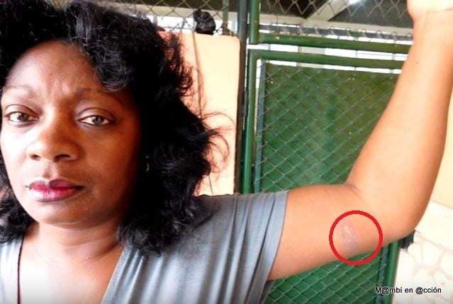Berta Soler muestra quemadura en su brazo luego de represión